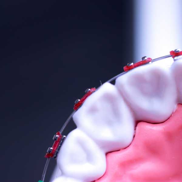 Ortodoncia tradicional en Clínica Dental Olmo