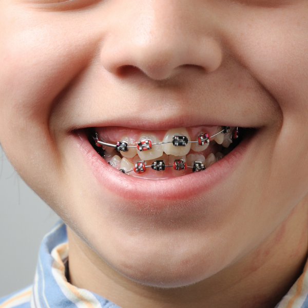 Ortodoncia infantil y juvenil con brackets metálicos