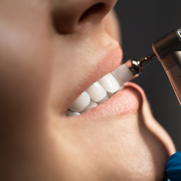 Limpieza bucal en Clínica Dental Olmo