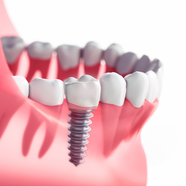 Implantes cigomáticos para pacientes con poco hueso en Córdoba